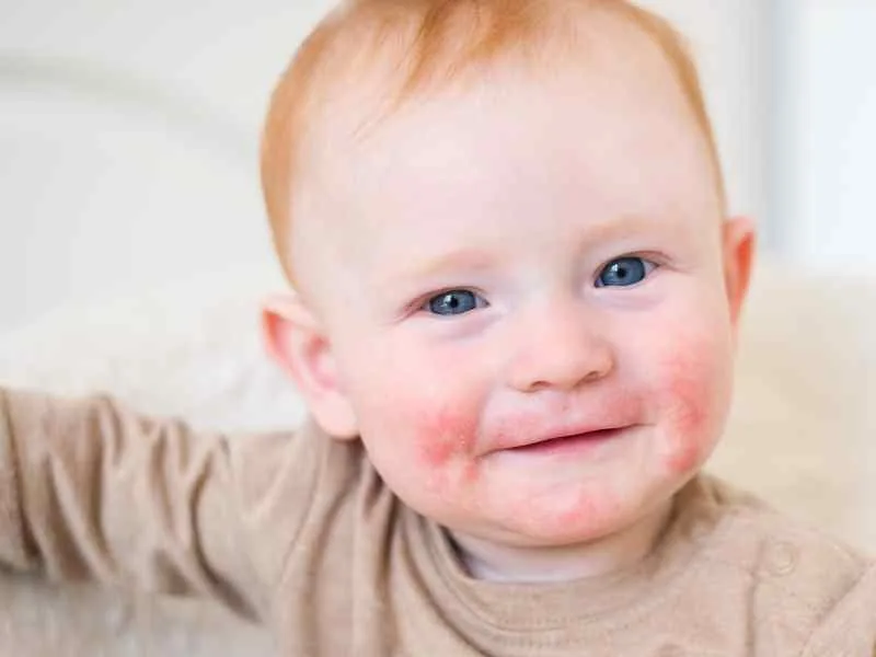 bebe dermatitis atopica