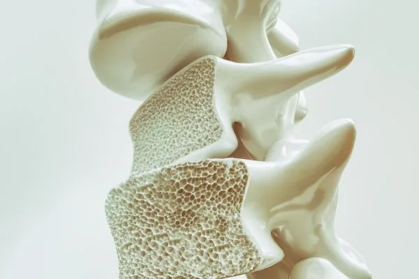 osteoporosis hueso
